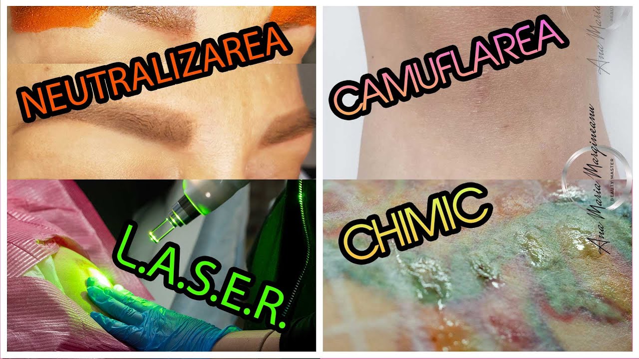 Metode de corectare a tatuajelor