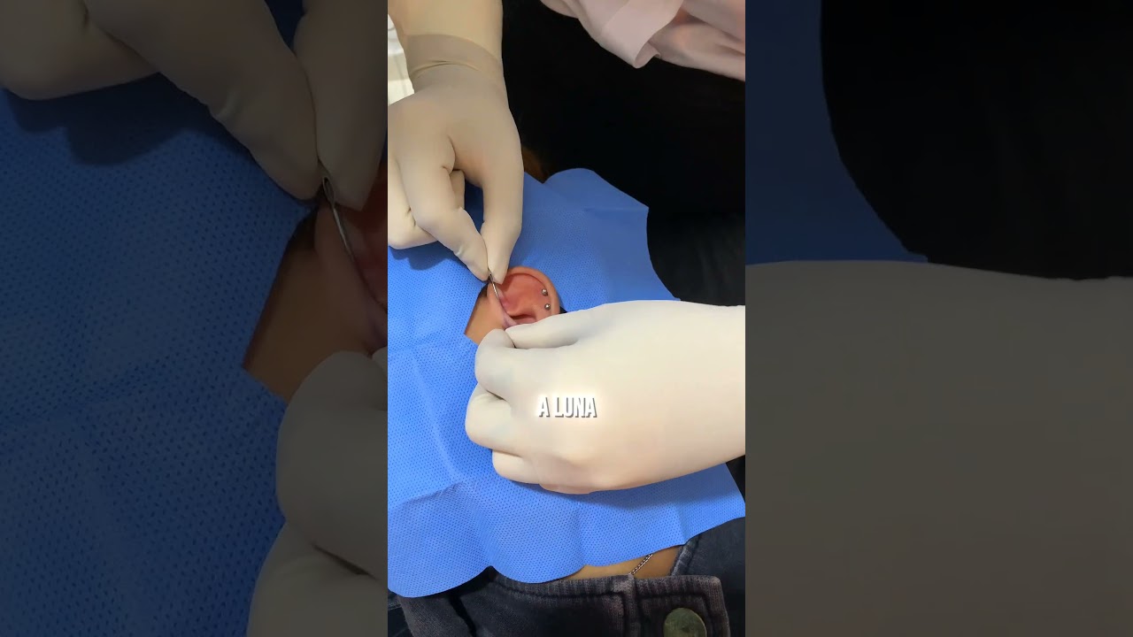 Daith Piercing ✨ Perfuração realizada pela minha aluna no curso de Body Piercing 