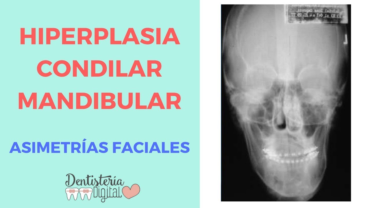 Hiperplasia Condilar Mandibular - Asimetrías Faciales