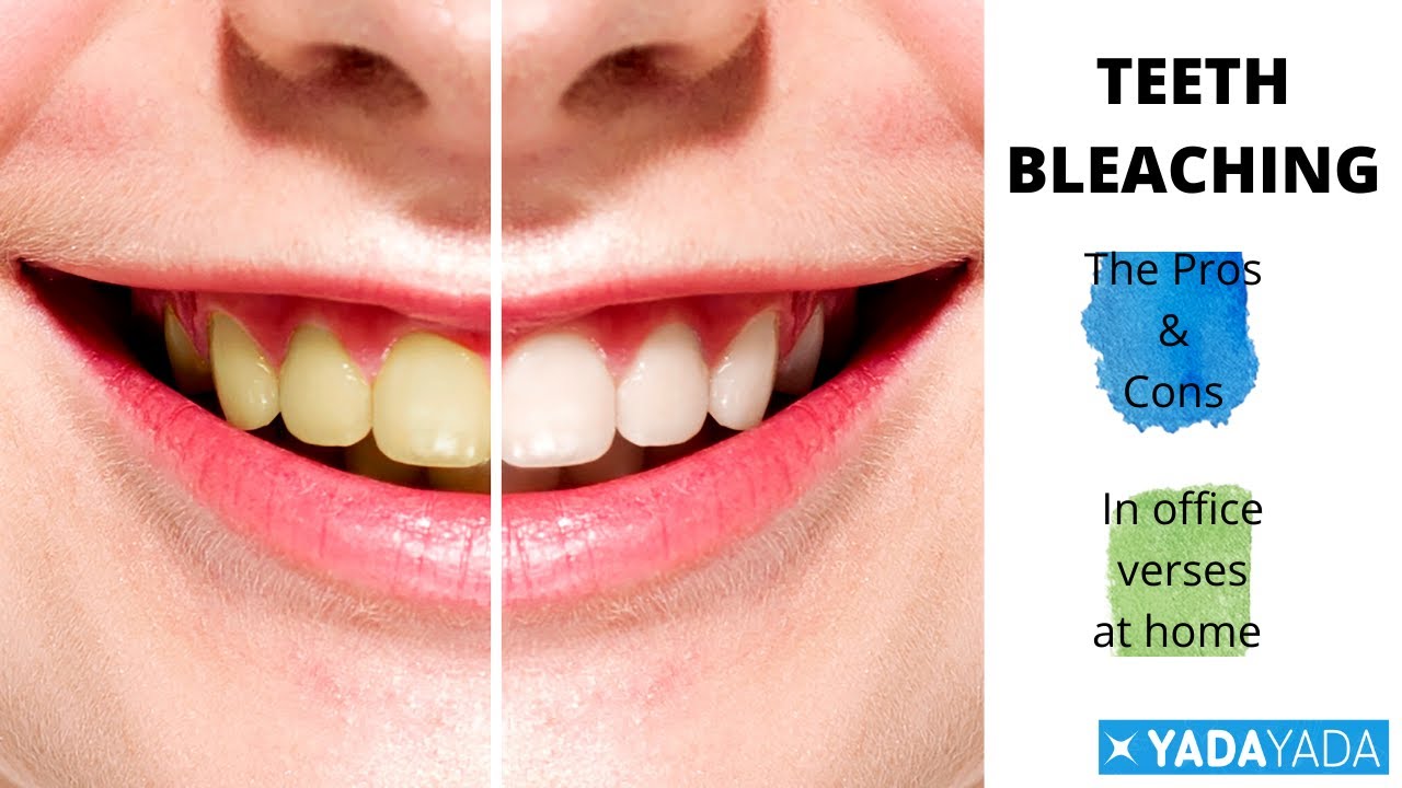 Teeth Whitening Explained.