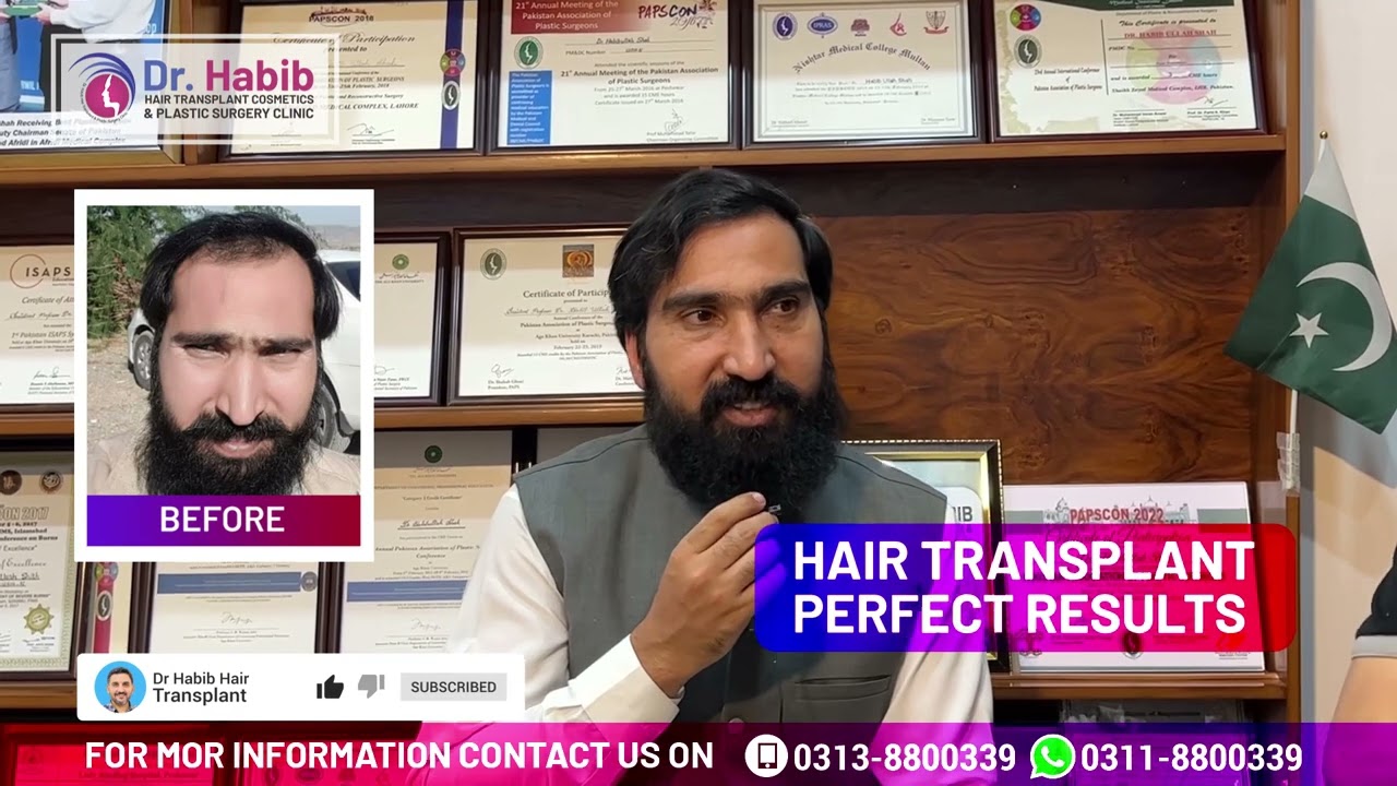 Live Hair Transplant Result of Dr. Sohail | Hair Transplant Result | Dr Habib Hair Transplant Clinic