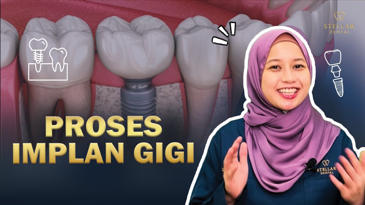 Proses Implan Gigi : Cara Popular Ganti Gigi Hilang?