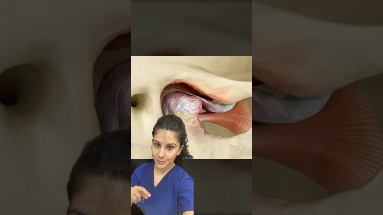 TMJ Arthritis | TMJ Dislocation | TMJ Pain | Lock Jaw- Dr.Pratibha #shorts #dental #tmj #viral