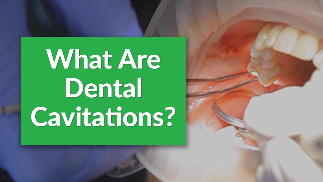 What Are Dental Cavitations & How Are They Treated?