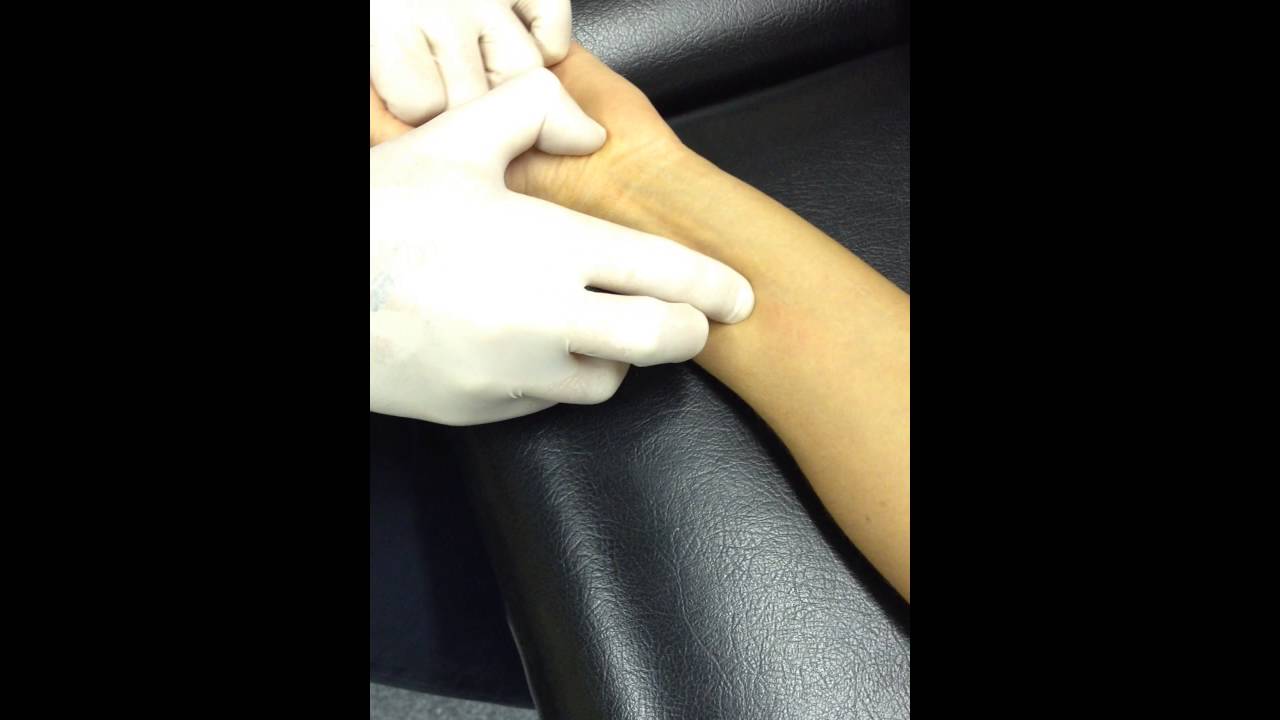 Flexor Pollicis Longus Dry Needling