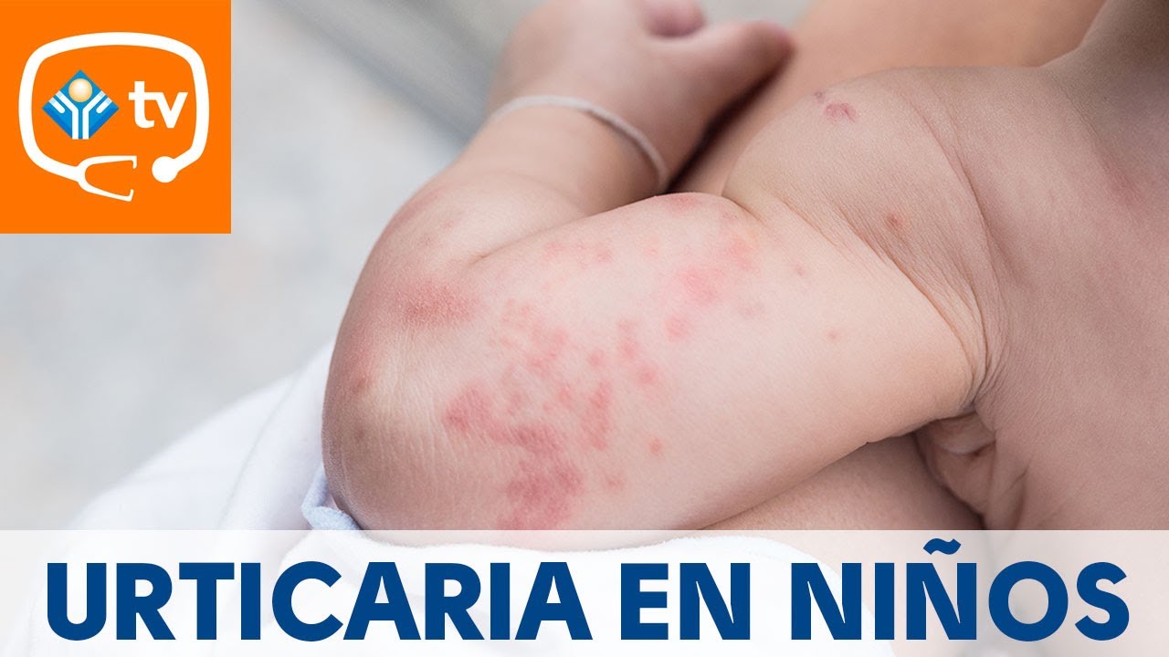 Urticaria en niños, ¿cómo se produce? ¿Tiene importancia?