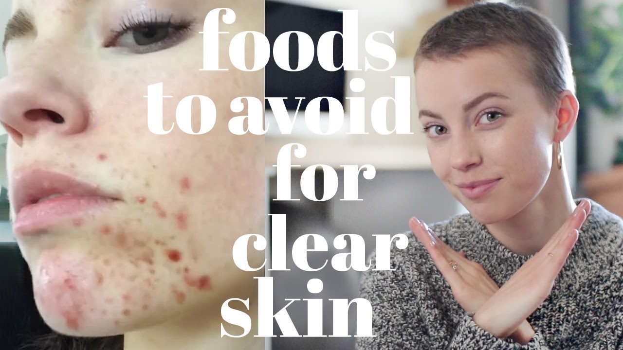 Foods To AVOID For Clear Skin