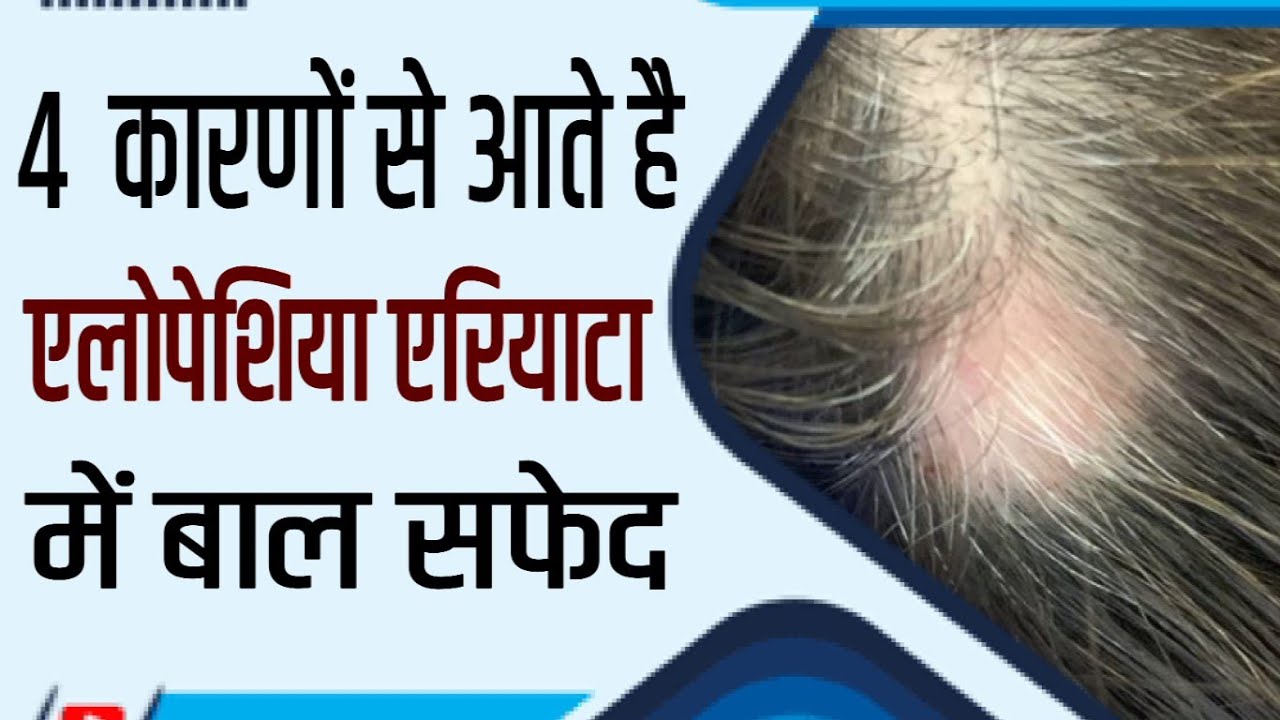 Why Grey Hair in Alopecia Areata ? | Dr Mukesh Aggarwal
