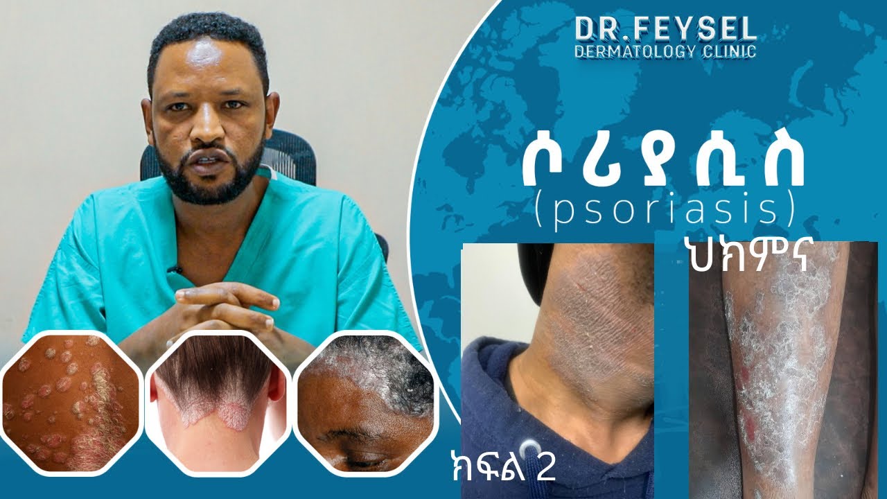 ሶርያሲስ ህክምና- ክፍል 2