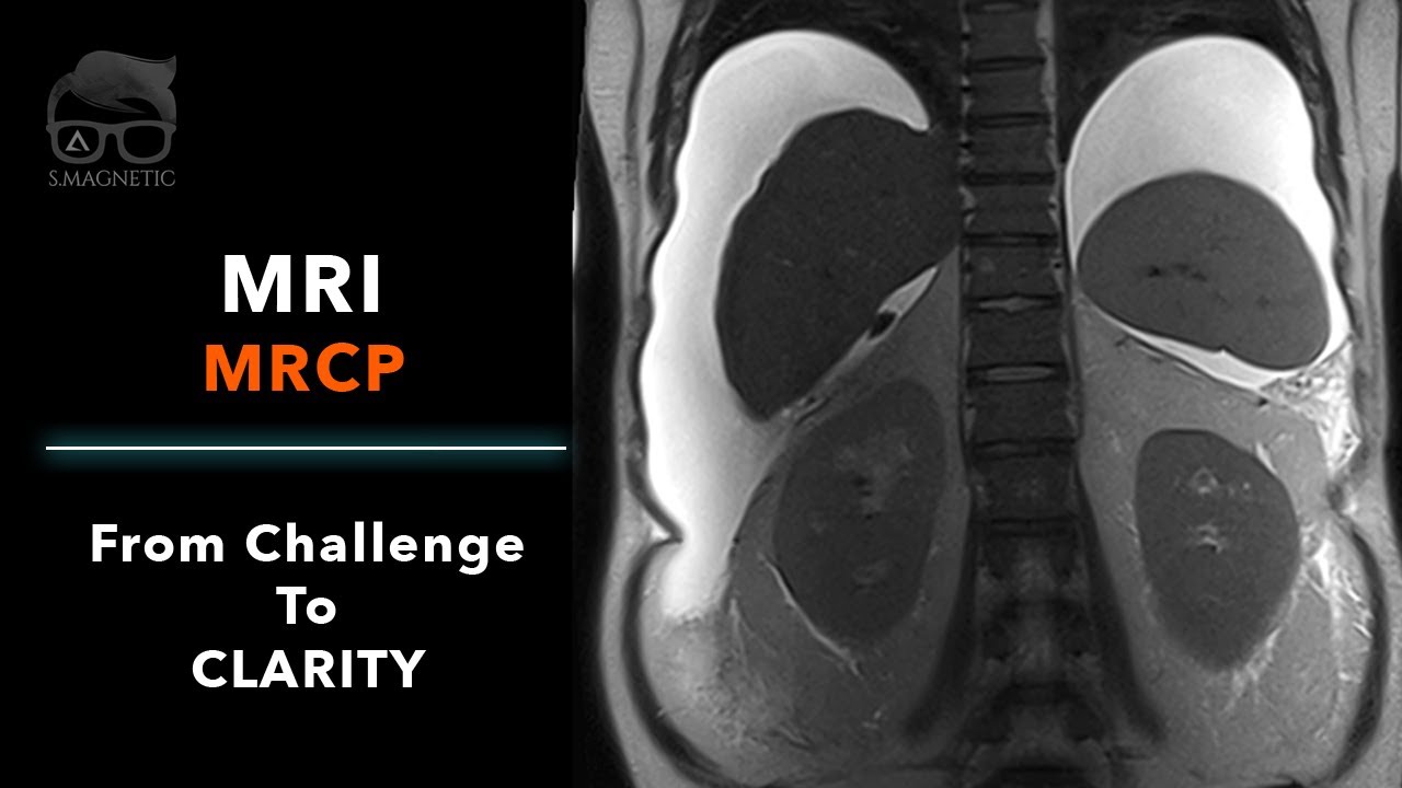 MRI MRCP– FROM CHALLENGE TO CLARITY