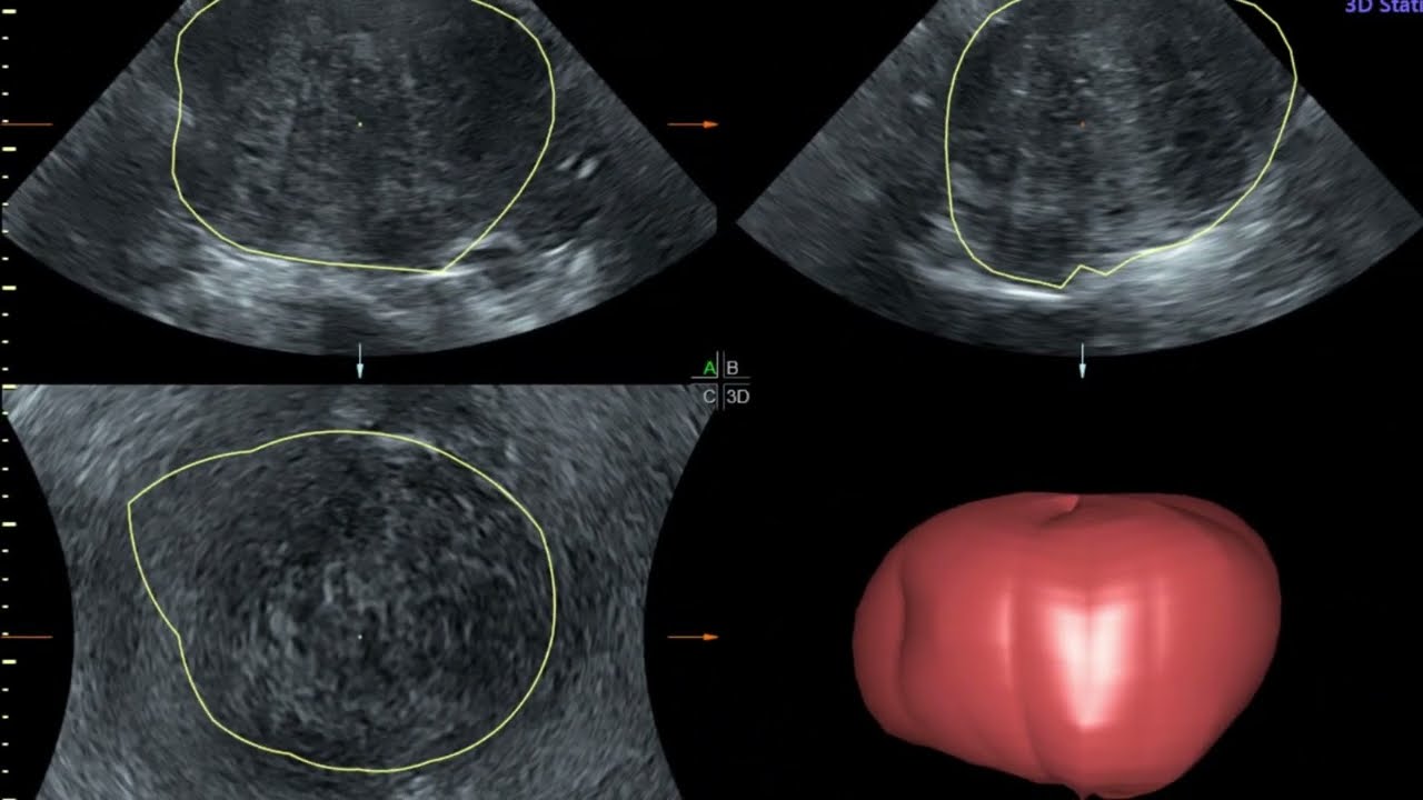 Adenomyosis Symptoms | Adenomyosis Treatment