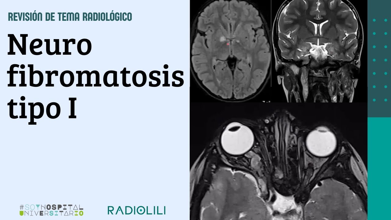 Neurofibromatosis tipo I
