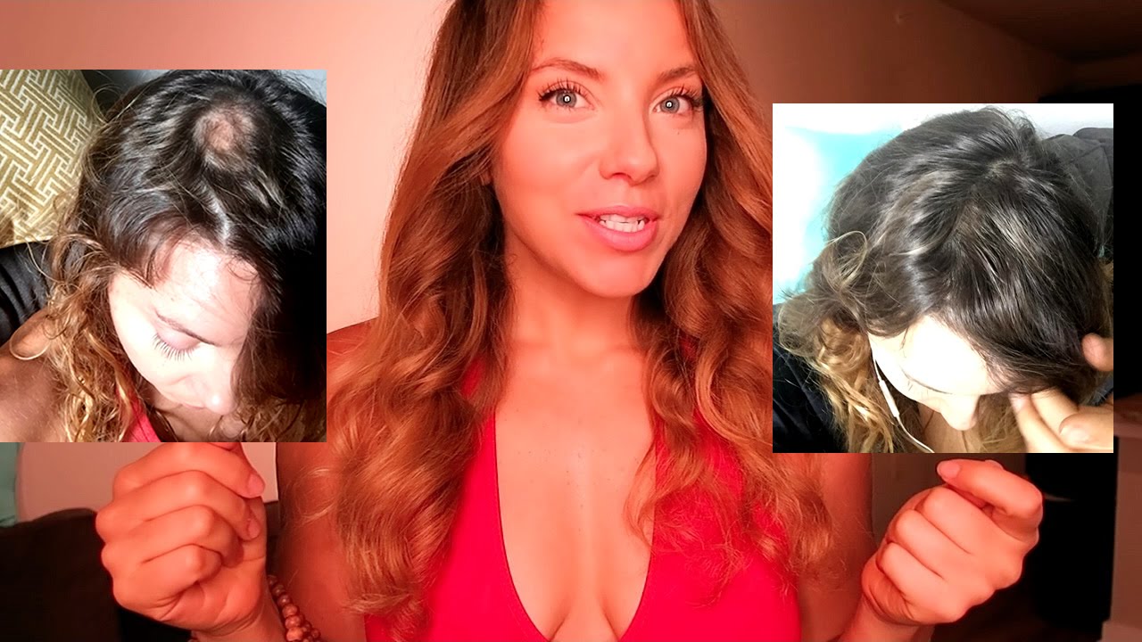 HOW TO HEAL ALOPECIA AREATA