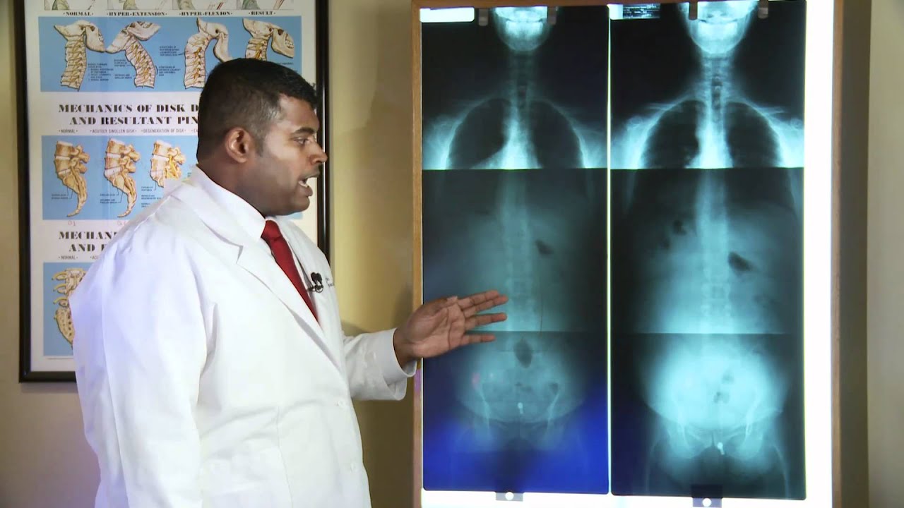 A Classic Example of a Patient Who Needs Chiropractic Care: A Before and After X-Ray
