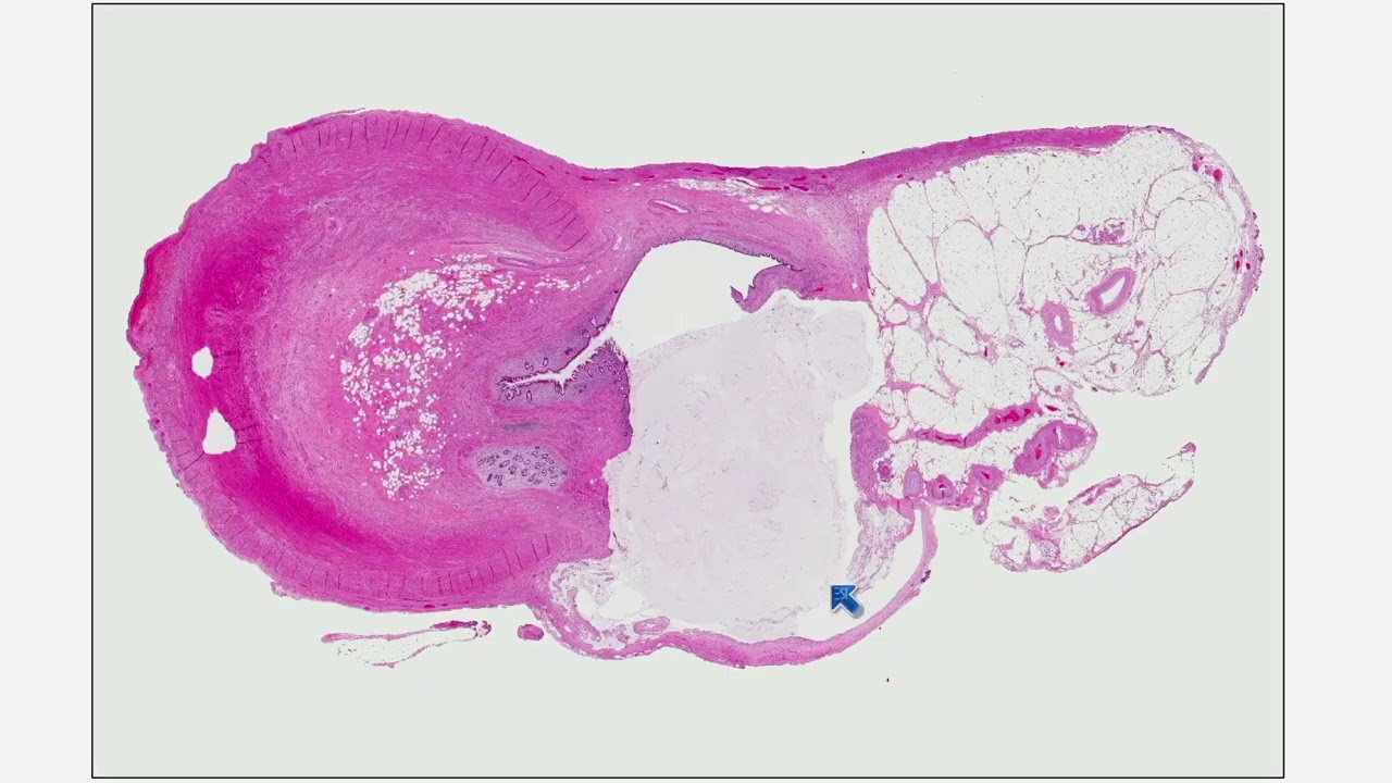 2025 A Practical Approach to Surgical Pathology: Volume XI