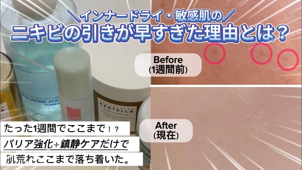 【1週間でニキビ改善】肌荒れループから、バリア強化×鎮静だけでここまで改善！