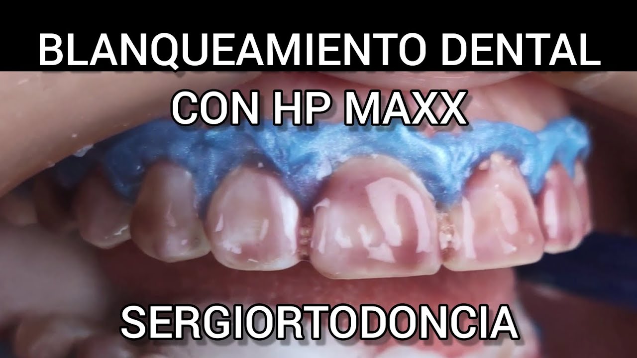 Blanqueamiento Dental con HP MAXX® (RESUMEN)