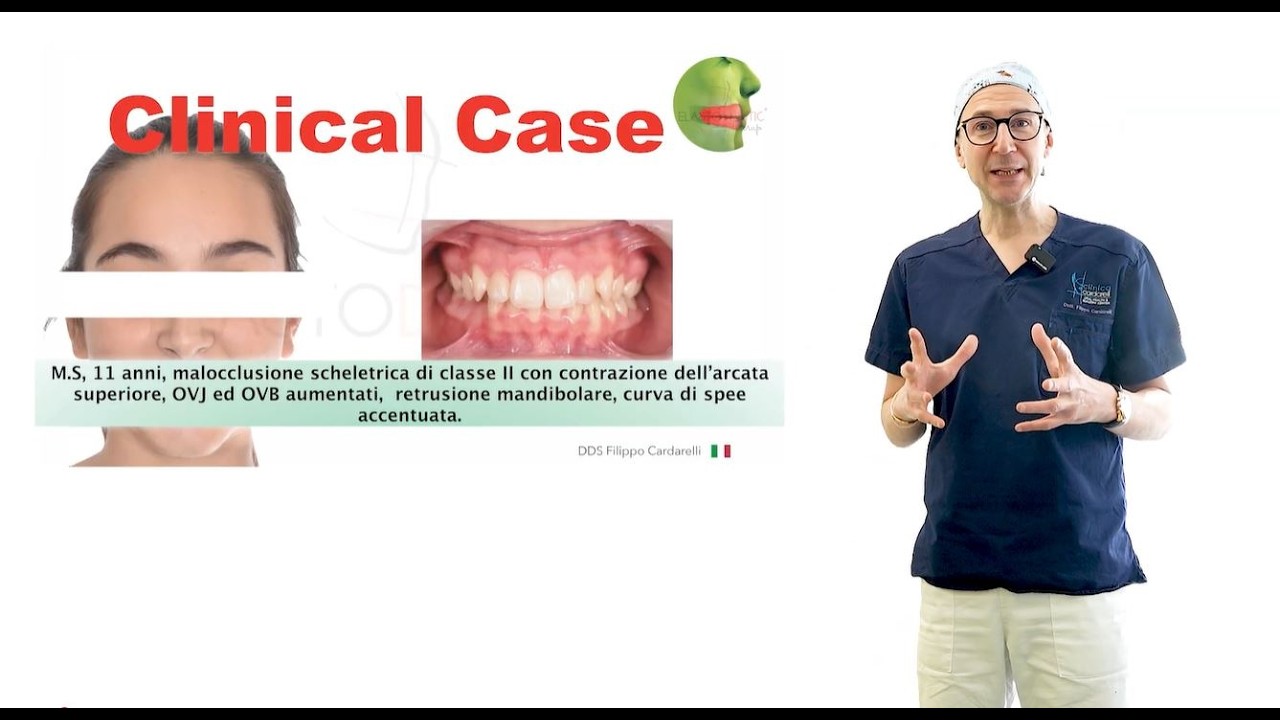 Malocclusione di II Classe Trattamento con Bio-Hybrid Technique  -  Dr. Filippo Cardarelli