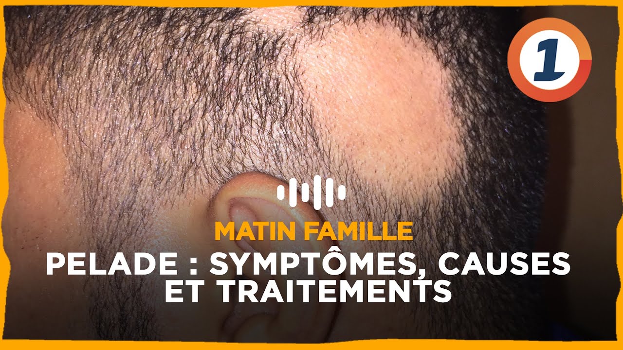 Pelade Sympt&ocirc;mes, causes et traitements