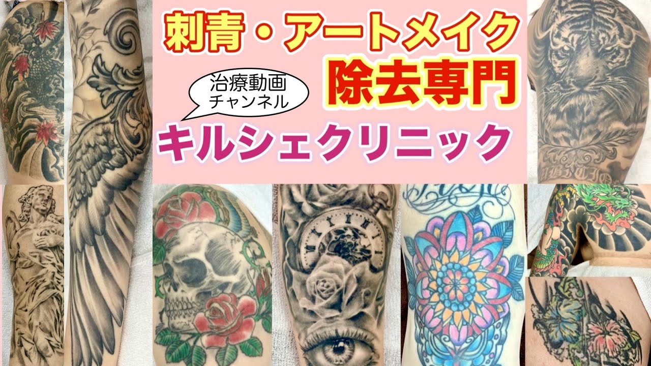 【ピコレーザー】レーザーによるタトゥー除去921【ピコウェイ＆エンライトン】