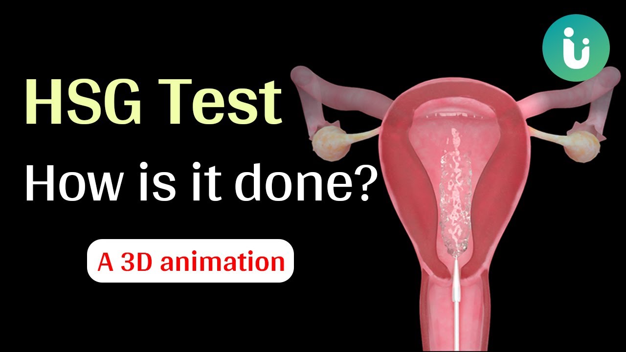 What is HSG test and how is it done? A 3D medical animation