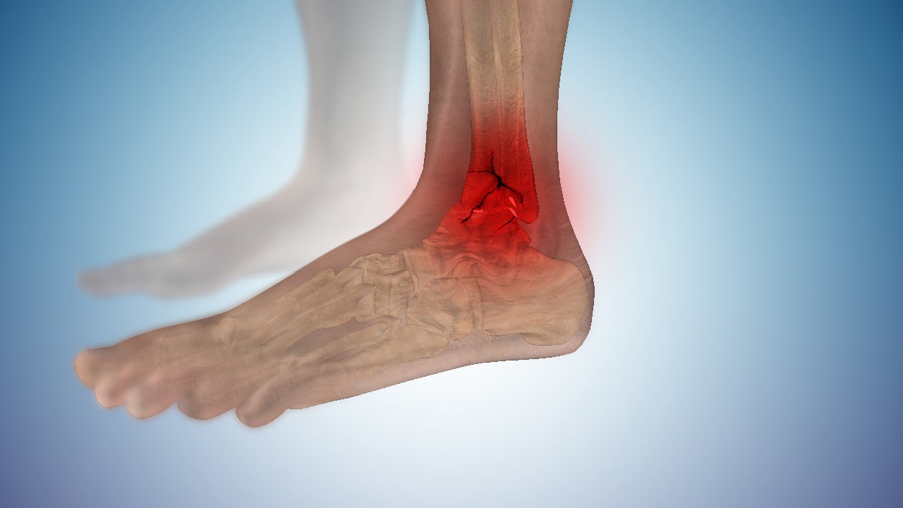 Broken Ankle or Ankle Fracture