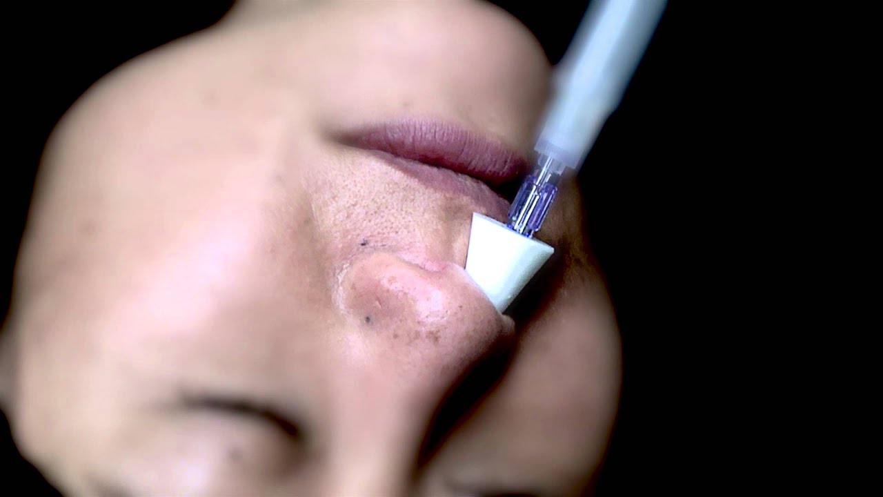 Использование назального налоксона для купирования передозировки опиатами