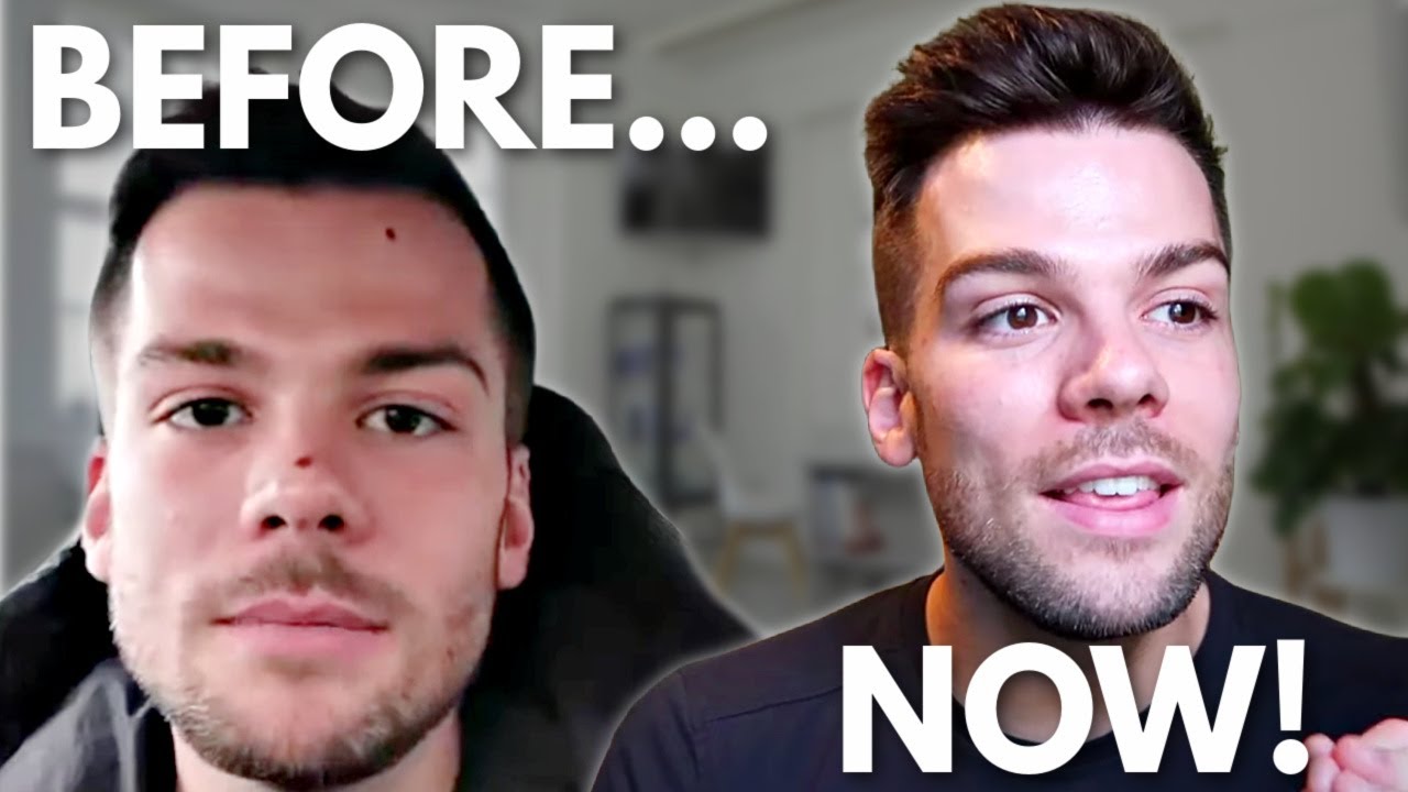 Facial Mole Removal | Healing Process and Before and After