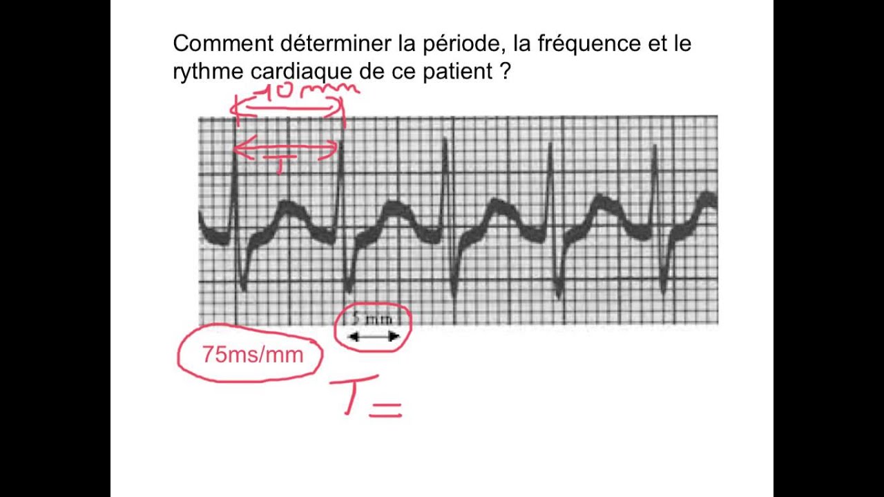 Exploiter un ECG