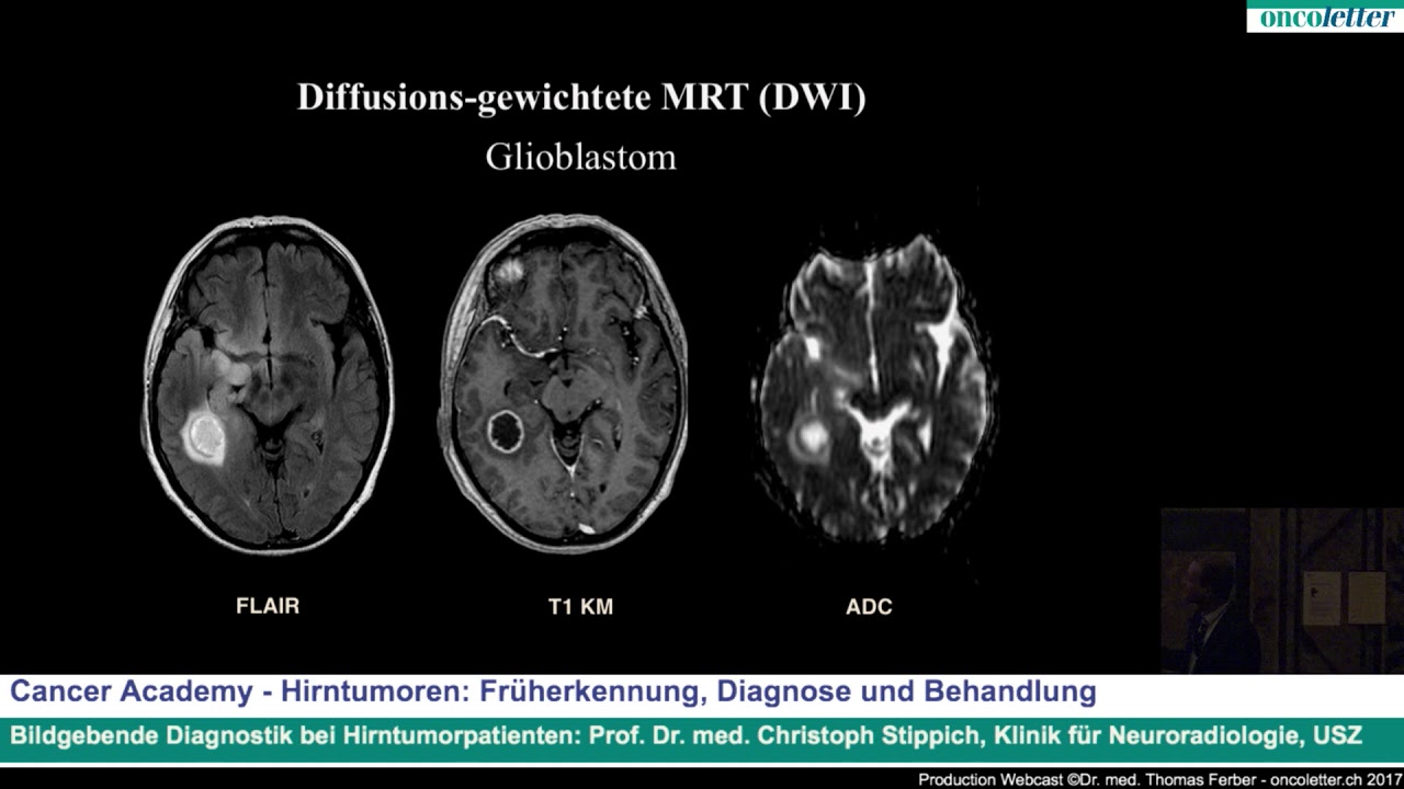 Christoph Stippich: Bildgebende Diagnostik bei Hirntumorpatienten