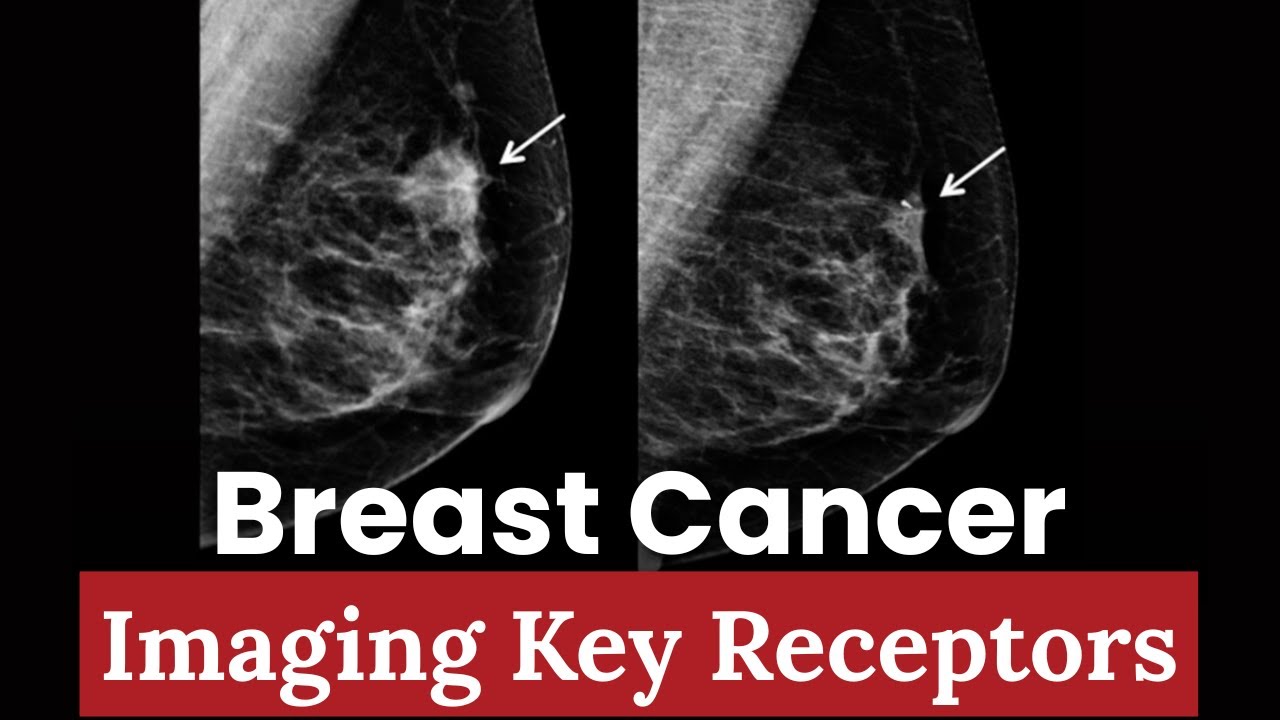 Оценка статуса рецепторов эстрогена при раке молочной железы