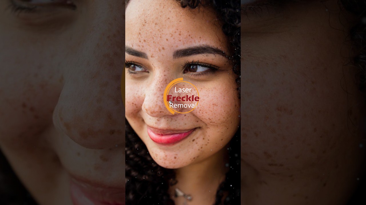 ✨Laser Freckle Removal💥@DermaVue #freckles #freckle #frecklestreatment