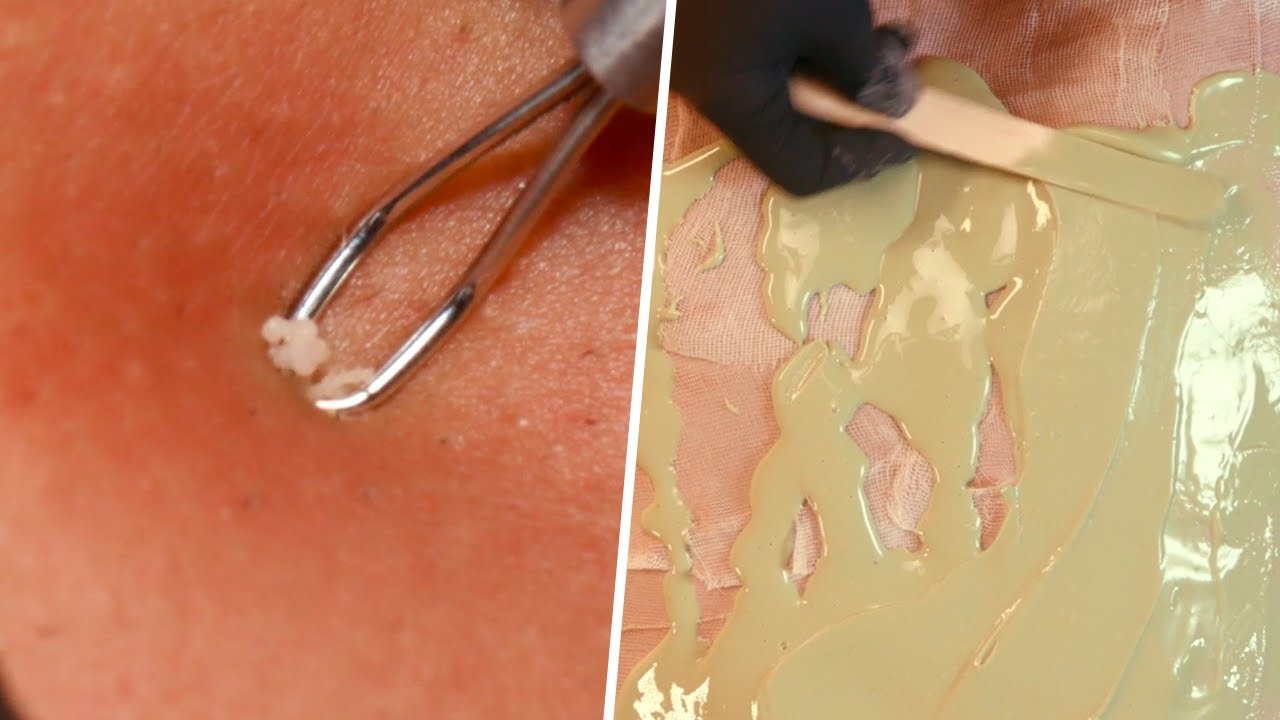 How To Get Rid Of Back Acne | Skincare Treatment