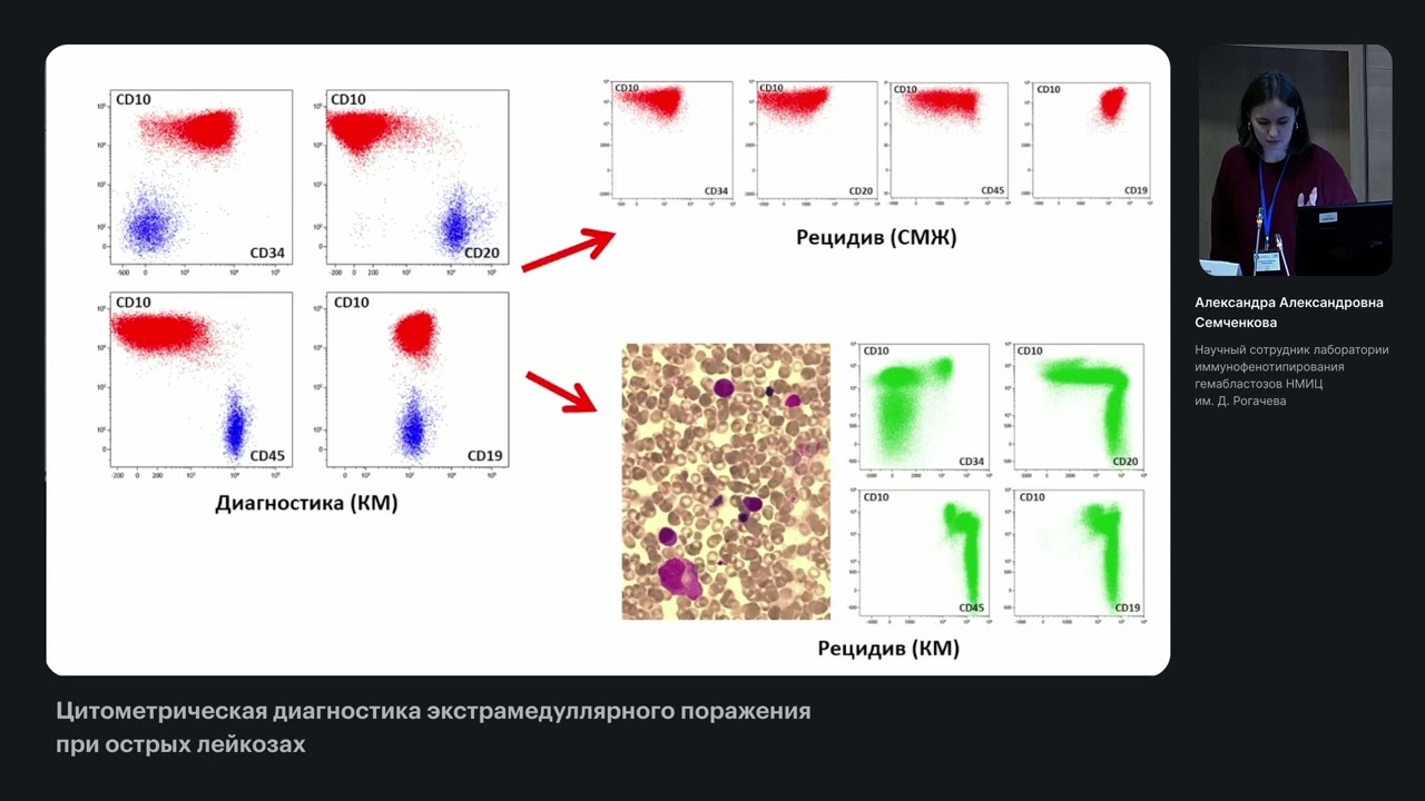 Цитометрическая диагностика экстрамедуллярного поражения при острых лейкозах