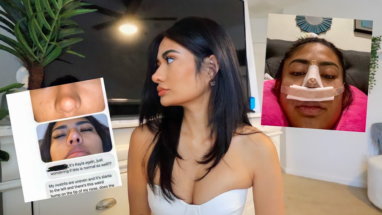 why my $19k nose job wasn't worth it...| RECOVERY, PHOTOS, EXPERIENCE