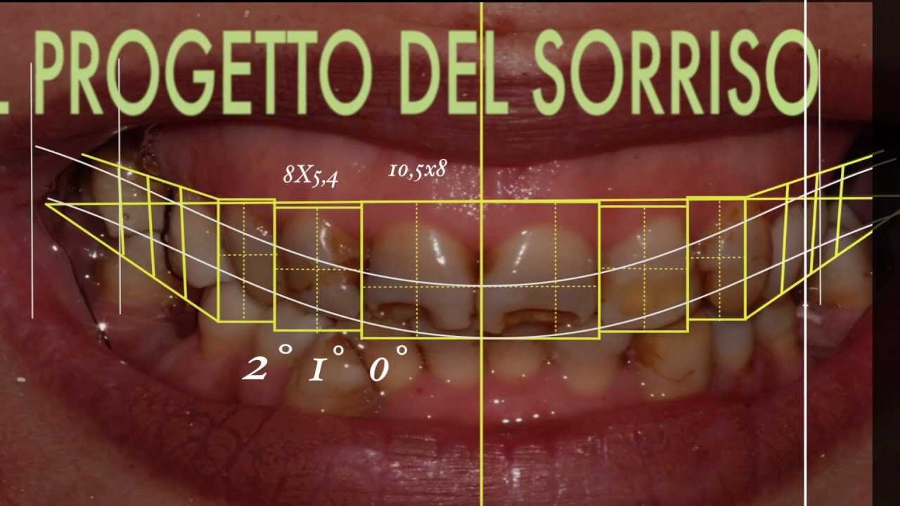 Cambiare l'aspetto del sorriso con faccette dentali | SMILE DESIGN