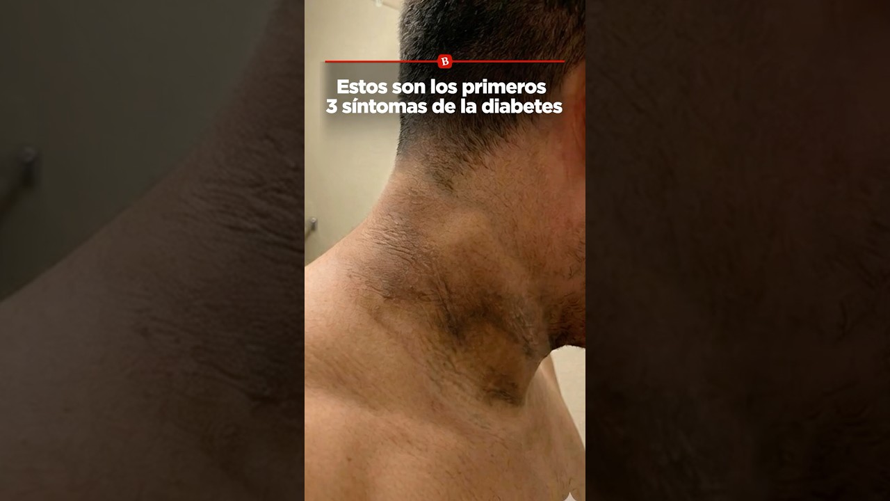 Estos son los primeros 3 s&iacute;ntomas de la diabetes