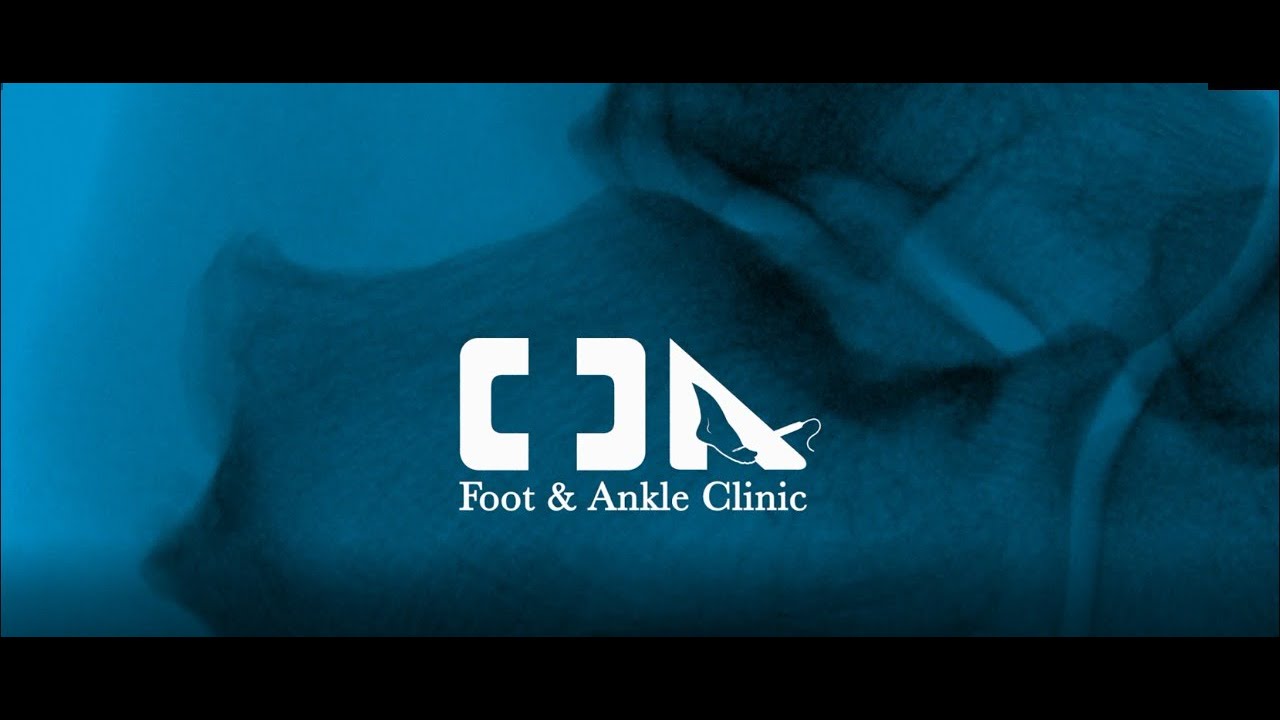 Minimally Invasive Haglund's Deformity Surgery