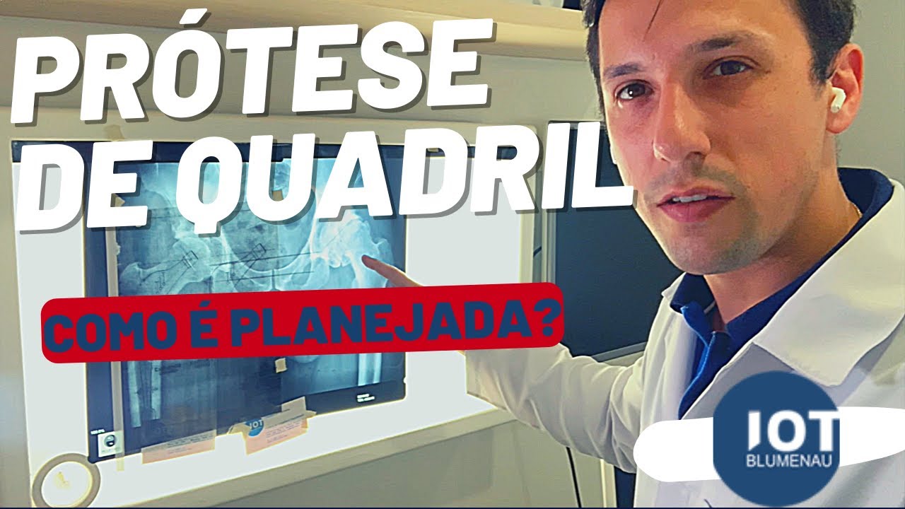 Planejamento de Pr&oacute;tese Total do Quadril