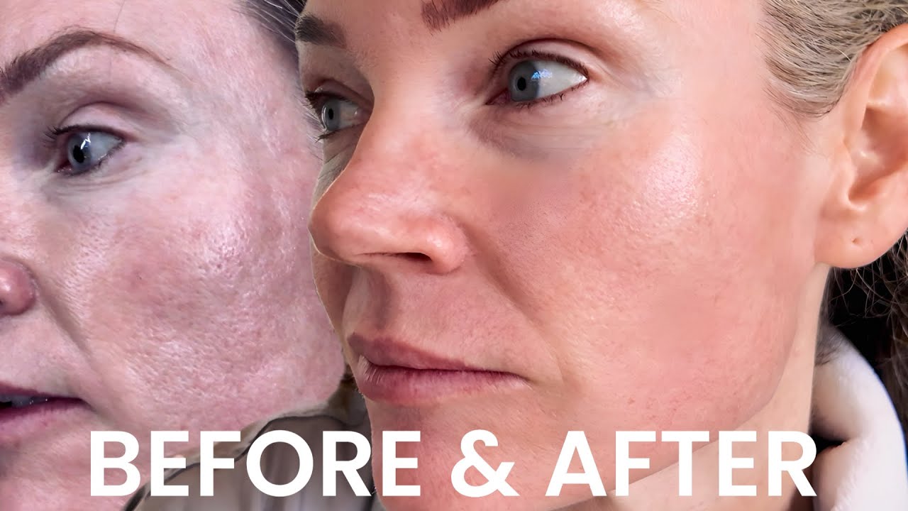 VBEAM Face LASER Treatment: 2 Weeks Before and After