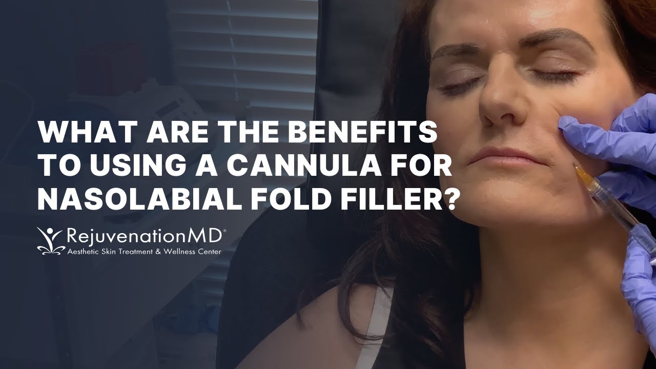 Cannula Artistry: Transforming Nasolabial Folds with Filler