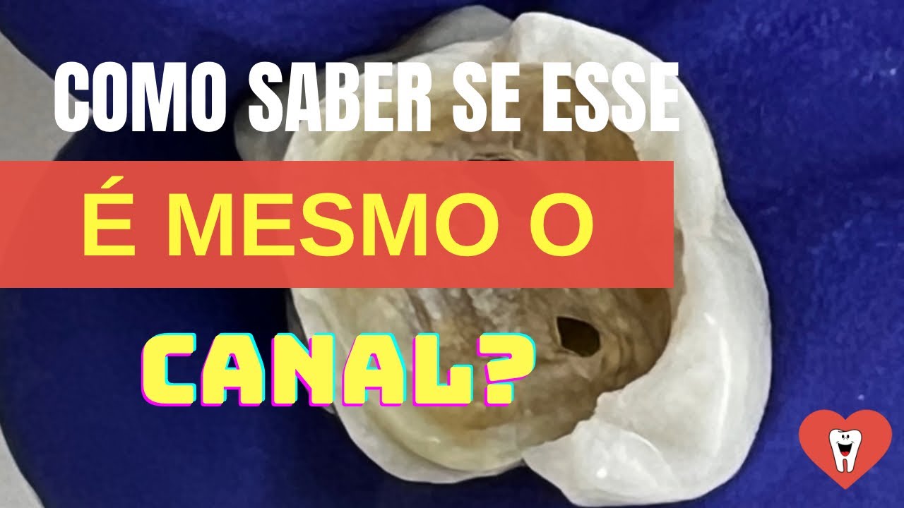 DICA 100% CLÍNICA PRA DIFERENCIAR CANAL E FURCA [SEM PERFURAR O DENTE!]