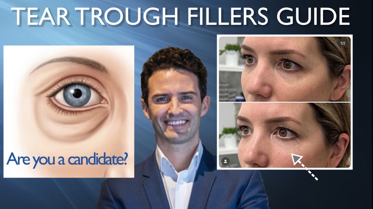 Tear Trough Guide: Are you a candidate?