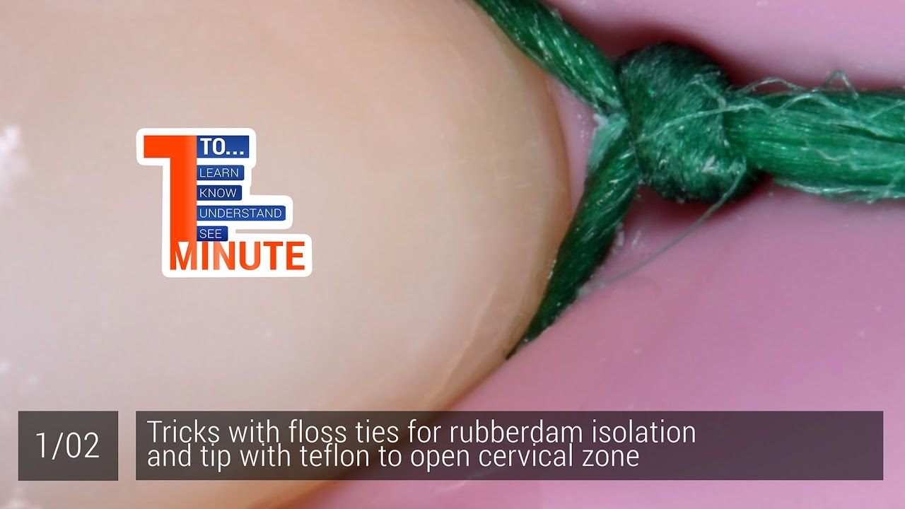 Tricks with floss ties for rubberdam isolation and tip with teflon to open cervical zone