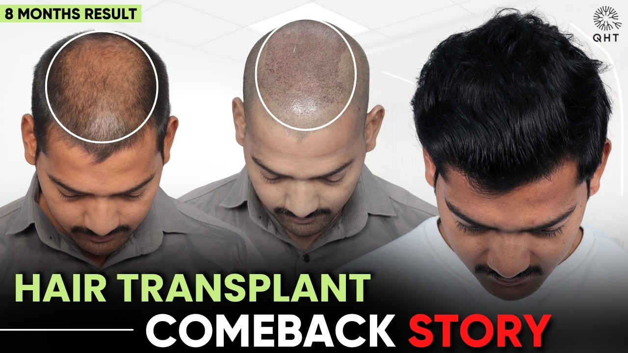 Amazing Transformation: 8 Months Hair Transplant Comeback Story | Hair Transplant results | QHT