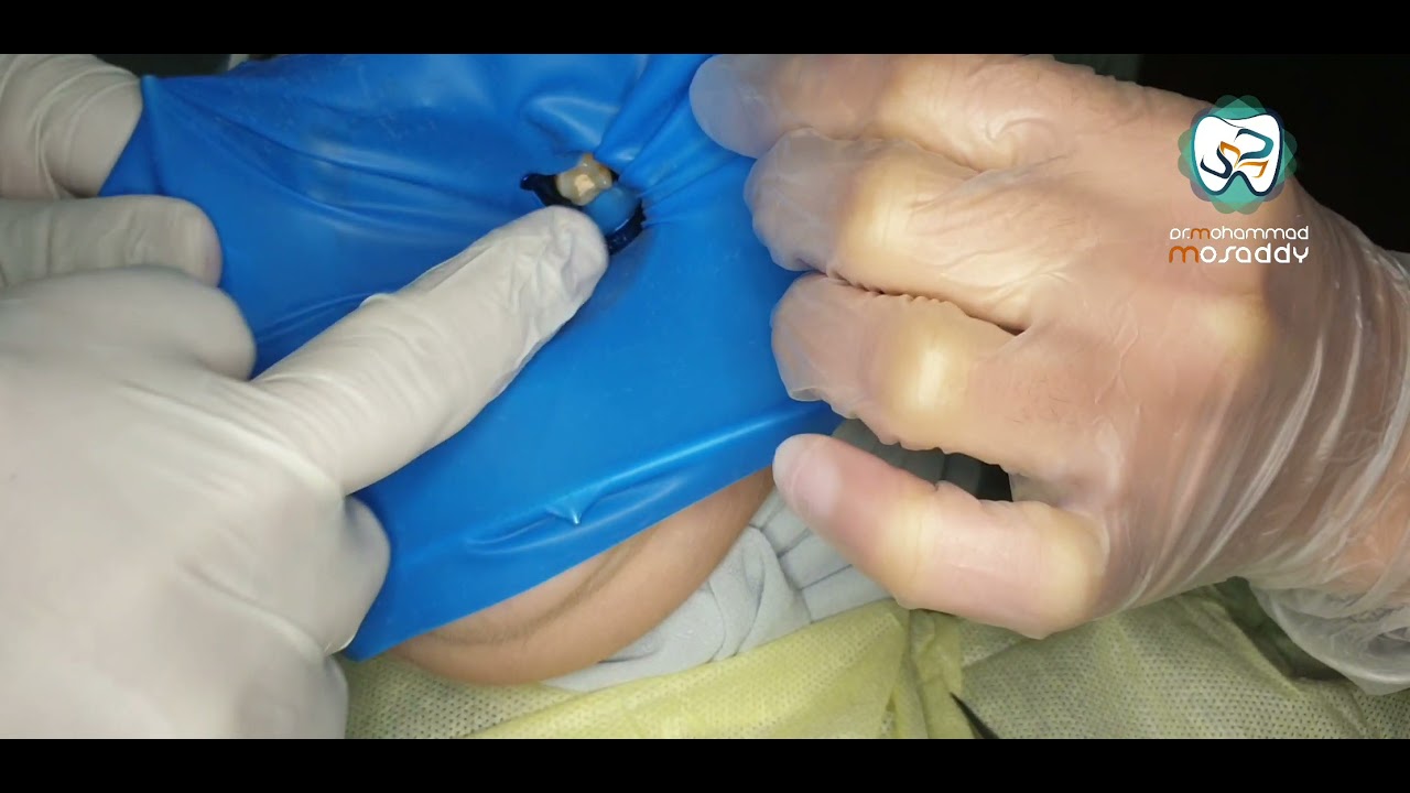 تركيب الحاجز المطاطي لسن خلفي من أجل اندو