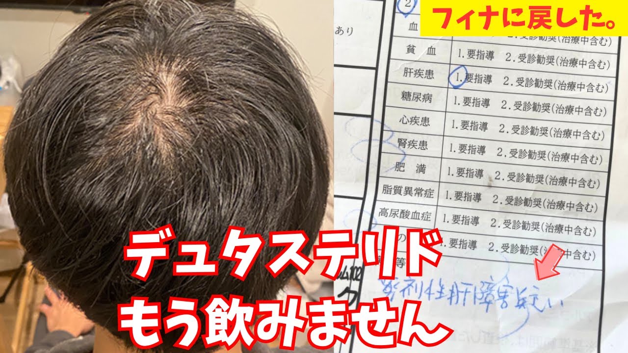 デュタステリドからフィナステリドに戻した理由&hellip; デュタの副作用で注意したいこと。