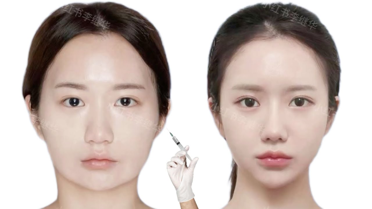 [💉] zygoma & square jaw reduction ୨ৎ