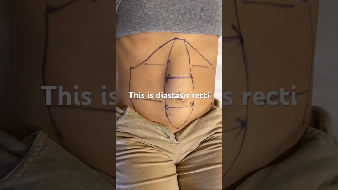This is a case of #diastasisrecti , Dr. Darecchio is the creator of this scarless robotic technique