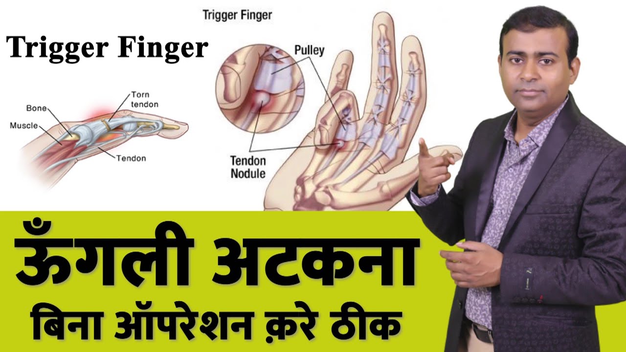 ऊँगली अटकना बिना ऑपरेशन क़रे ठीक I trigger finger treatment without oration